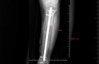 İş kazası geçiren hastaya boy uzatma ameliyatı...