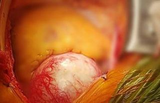 Aort damarı 3 kat büyüyen hasta ölümden döndü