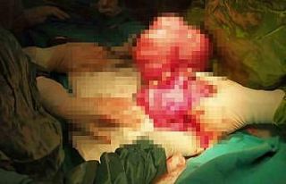 Kilo aldığını sanıyordu, karnından çıkanlar...