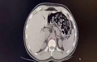 Mide ve bağırsağından 65 kapsül uyuşturucu çıktı