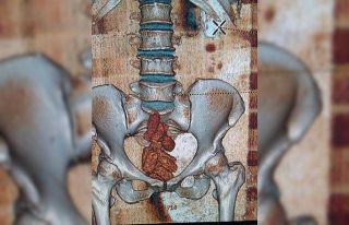 Uyuşturucu maddeyi bağırsaklarında saklamışlar