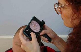 Uzmanlar uyardı: Ciltteki benler kansere dönüşebilir