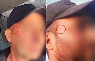 Jandarma korkusundan yüzündeki beni aldırdı