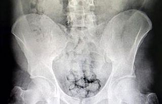 Uyuşturucuları midelerine sakladılar, polis tarafından...