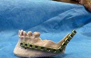 3D modelleme üzerinde test yapıldı, ardından hastaya...