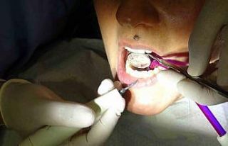 Kanal tedavisi ile dişi kurtarmak mümkün