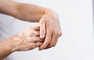 Leke tedavisinde en önemli adım güneşten korunmak