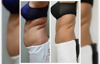 Tek seansta 3.5 santim incelme mümkün