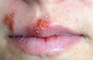 Uçuk deyip geçmeyin