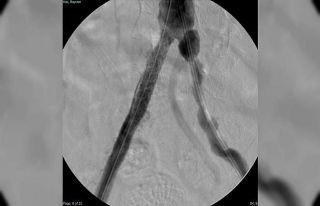 Türkiye’nin ilk yerli stent grefti başarıyla...