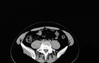 Uzmanından yaz aylarında çok görülen sistit uyarısı
