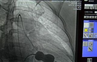 Alanya’da mitral kapak darlığı ameliyatsız tedavi...