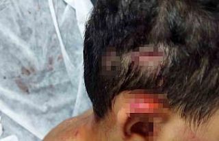 Köpeğin saldırısına uğrayan çocuğun kafasında...