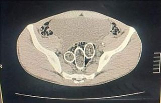 320 gram uyuşturucuyu mide ve rahme sakladılar
