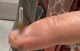 Eline dikiş iğnesi saplanan kadın hastanelik oldu