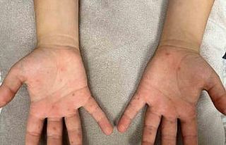 Uzmanı uyardı, bu hastalık hafife alınmamalı