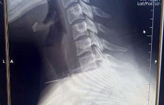 Kadının boğazına saplanan iğne ameliyatla çıkarıldı