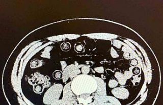 Muş’ta midelerinden 928 gram uyuşturucu çıkan...