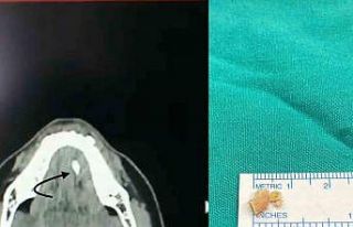 Ağızdaki sessiz tehlike: Tükürük bezi taşı...