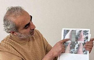 Jeoloji mühendisi sedef, egzama, uyuz ve vitiligo...