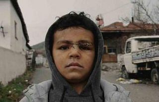 Sokak köpeği 5 yaşındaki çocuğun yüzünü parçaladı