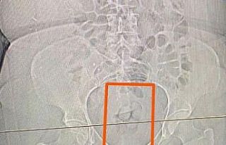 Midesinden 21,39 gram uyuşturucu çıktı