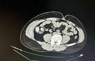 Bu kadarına da pes: Midelerinden 10 parça halinde...