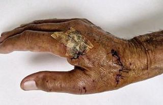 Duşakabin patladı, eline 20’ye yakın dikiş atıldı