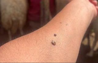 Erzincan’da KKKA uyarısı: Kene temasına karşı...