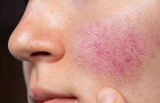 Gül hastalığı ihmal edilmemeli