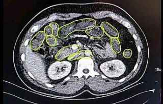 Mide ve bağırsaklarından uyuşturucu çıktı