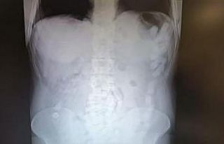 Midesinde uyuşturucu maddeyle yakalanan şahsa 12...