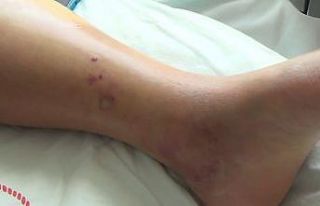 Tunceli’de koca engerek yılanının ısırdığı...