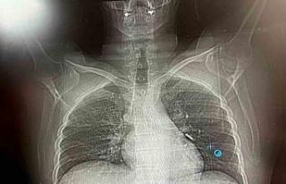 İmplant vidası ciğerine kaçan hasta ölümden...