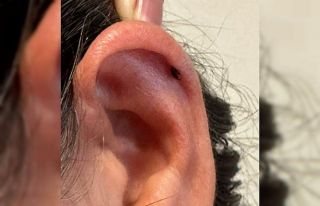 Kadının kulağını kene ısırdı