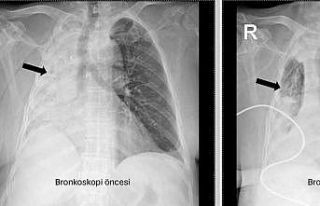 Nefes borusuna kaçan mısır tanesi 5 ay sonra ortaya...