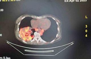 ’Sigarasız akciğer kanseri’ vakalarında dikkat...