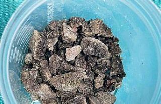 8 santimetrelik ’geyik boynuzu’ böbrek taşı...