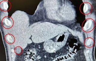 Midelerinden 136 kapsül uyuşturucu çıktı