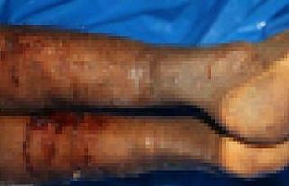 İsrail’in iade ettiği cenazelerde işkence izleri...