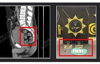 Tomografide şok eden görüntü...Uyuşturucu midesinden...