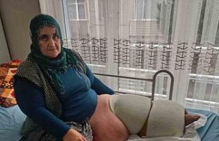 Fil hastalığı bacağını 100 kilo yaptı, tedavisinin...