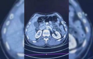 Ülkeye midelerinde uyuşturucu getiren şahıslar...