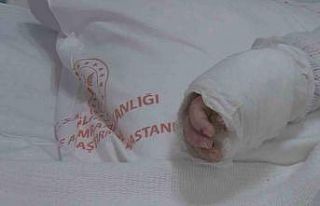 Üzerine kaynar su dökülen bebeğin vücudunun yüzde...