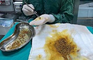 Bingöl’de nadir vaka: Safra kesesinden 2 bin 67...