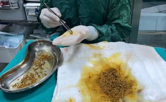 Bingöl’de nadir vaka: Safra kesesinden 2 bin 67 taş çıkarıldı
