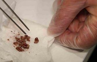 Elazığ’da estetik ameliyatta şaşırtan olay, burundan taş çıktı