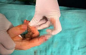 Bandırma’da asansör kazasında kopan parmak başarılı ameliyatla kurtarıldı