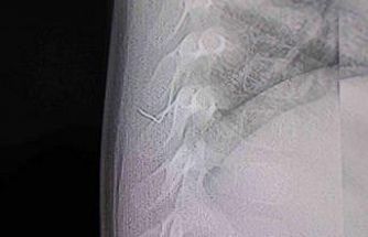 Bebeğin sırtından tel parçası çıktı