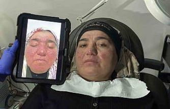 Hastalığı yüzünden yıllarca evden çıkamadı, şimdi ise çekinmeden çıkabiliyor